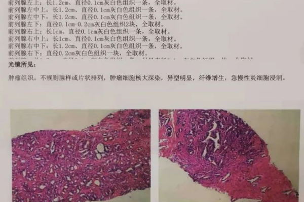 【学科建设】我市成功自主开展首例腹腔镜下前列腺癌根治术 【学科建设】我市成功自主开展首例腹腔镜下前列腺癌根治术
