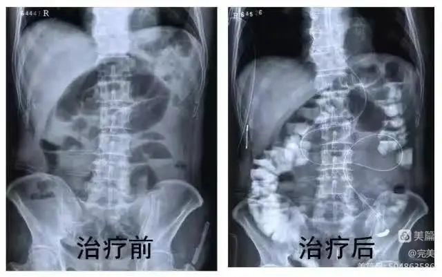 【学科建设●普外科】抚州市第一人民医院普外科开展DSA引导下肠梗阻导管置入术 【学科建设●普外科】抚州市第一人民医院普外科开展DSA引导下肠梗阻导管置入术